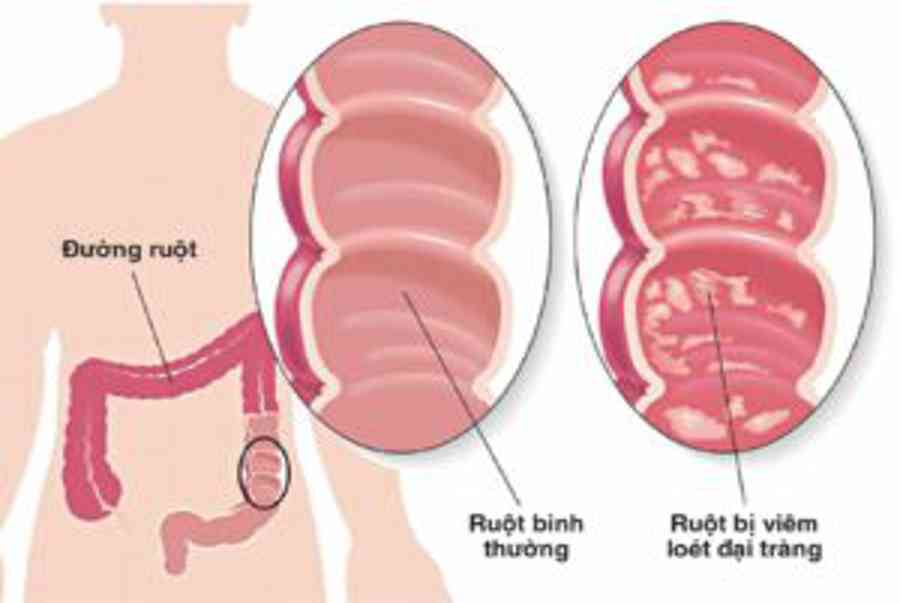 Viêm loét đại tràng: Hiểu đúng để chữa khỏi – YouMed