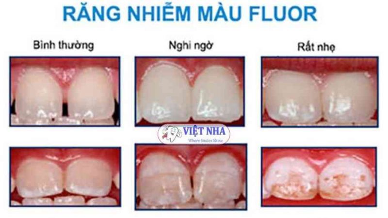 RĂNG BỊ Ố VÀNG, NHIỄM MÀU NGUYÊN NHÂN DO ĐÂU? CÁCH ĐIỀU TRỊ NHƯ THẾ NÀO? – Nha khoa Việt Nha