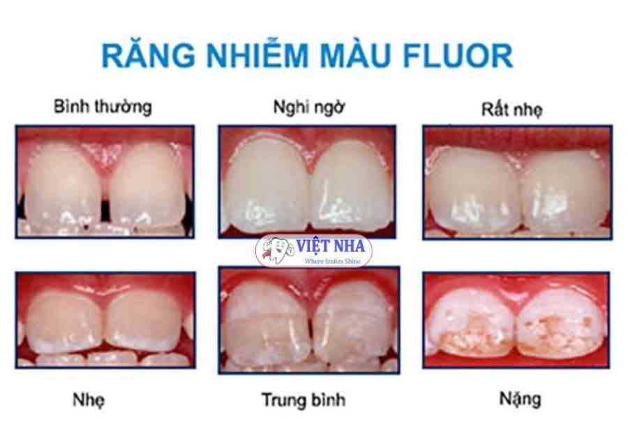 RĂNG BỊ Ố VÀNG, NHIỄM MÀU NGUYÊN NHÂN DO ĐÂU? CÁCH ĐIỀU TRỊ NHƯ THẾ NÀO? – Nha khoa Việt Nha