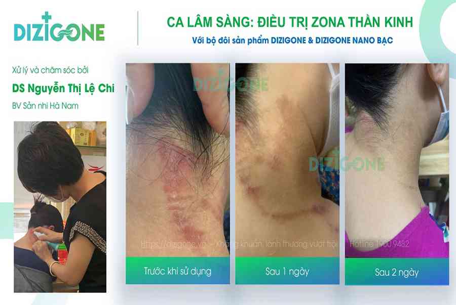 7 thuốc bôi zona hiệu quả nhanh – an toàn nhất – Dizigone – Kháng khuẩn vượt trội